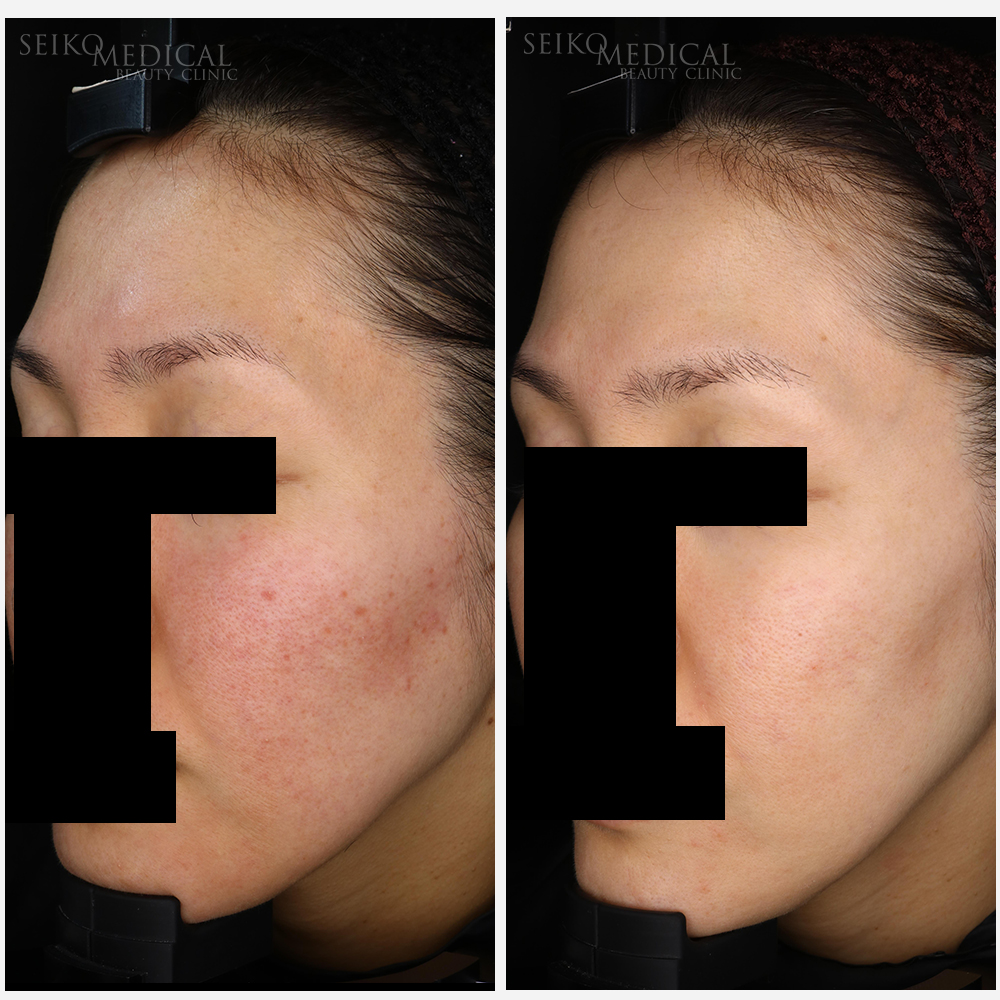 コラーゲンピール・ジェネシス５回、イオン導入７回　症例写真