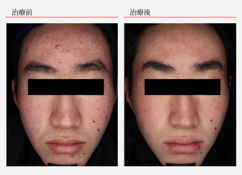 イソトレチノイン症例12