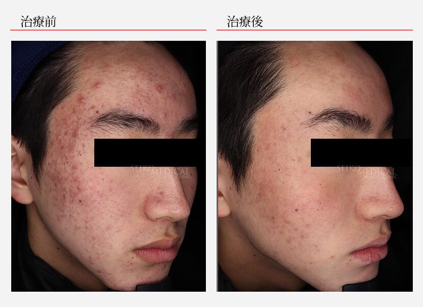 イソトレチノイン症例12