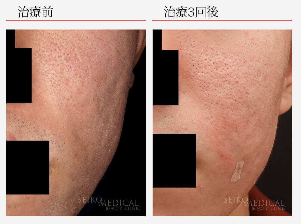 サブシジョン ヒアルロン酸注入