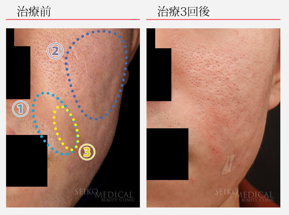 サブシジョン ヒアルロン酸注入