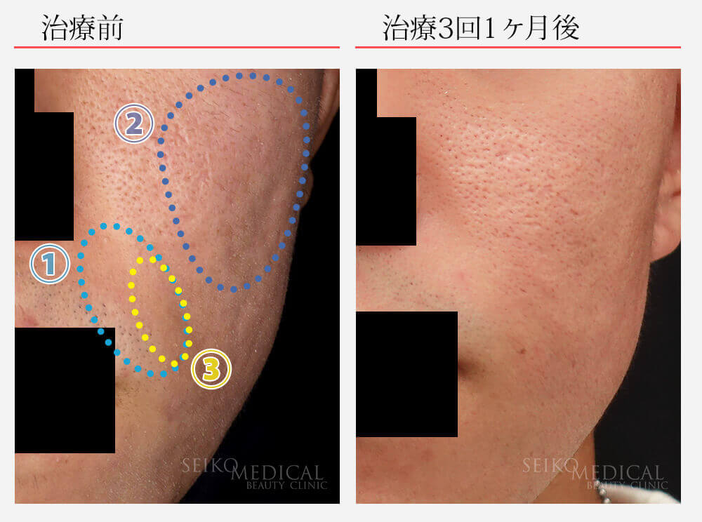 サブシジョン ヒアルロン酸注入