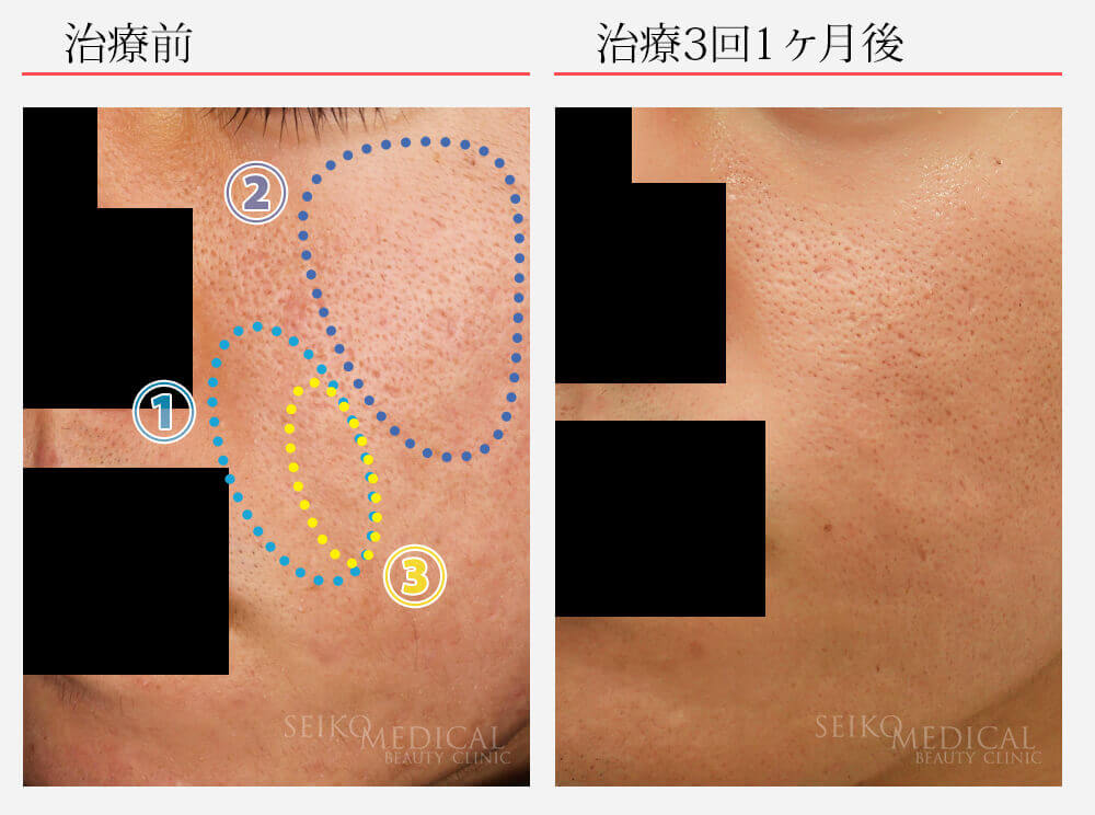 サブシジョン ヒアルロン酸注入